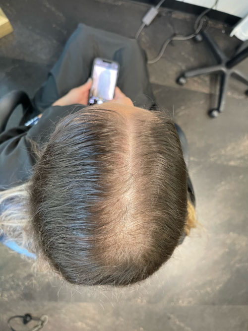 top view of woman before salon appt for hair replacement