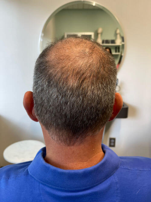 back view of man before salon appt for hair replacement