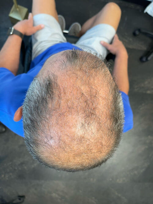 top view of man before salon appt for hair replacement